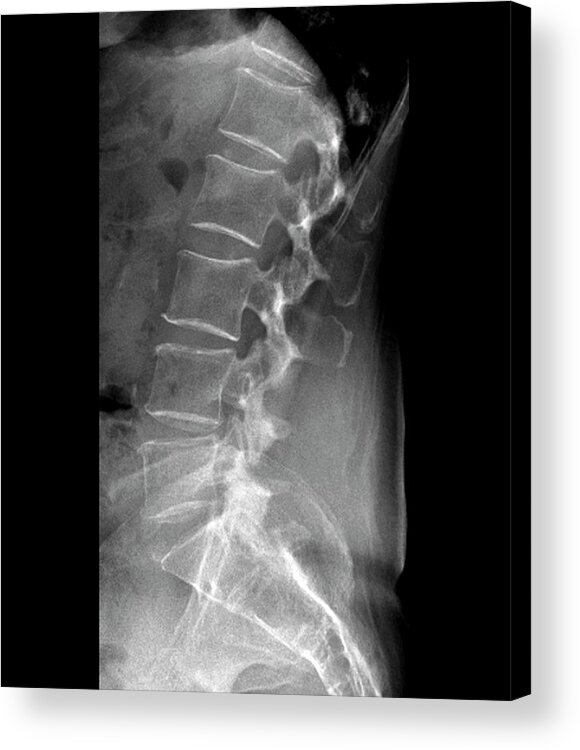 Black And White Acrylic Print featuring the photograph Spinal Stenosis After Surgery by Zephyr