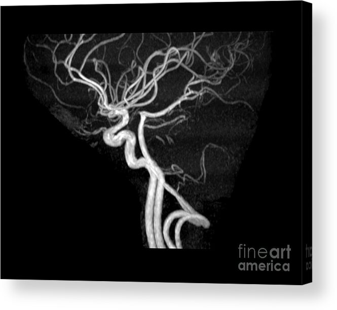 Intracranial Mra Acrylic Print featuring the photograph Normal Intracranial Mra #5 by Living Art Enterprises