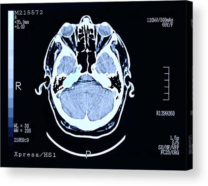 Tomography Acrylic Print featuring the photograph Brain scan by Peter Dazeley