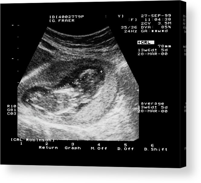 Intuition Bane Svarende til Foetus Ultrasound Acrylic Print by Simon Fraser/science Photo Library -  Fine Art America