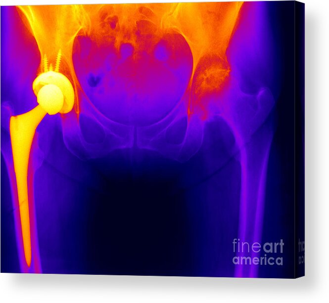 Surgical Acrylic Print featuring the photograph Hip Replacement #1 by Ted Kinsman