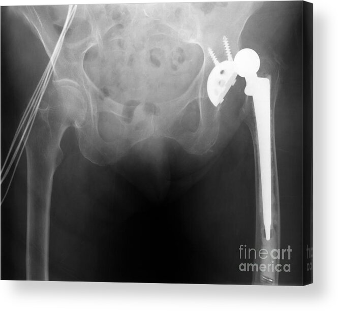 Surgical Acrylic Print featuring the photograph Hip Replacement #2 by Ted Kinsman