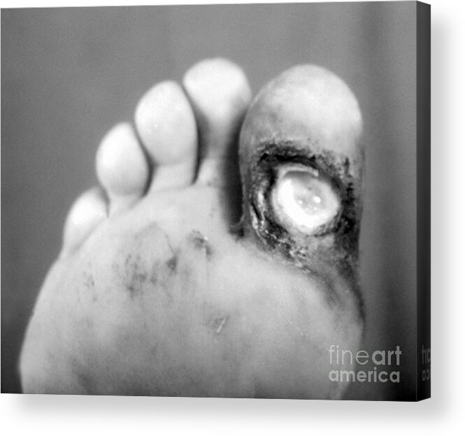 Bacterial Acrylic Print featuring the photograph Syphilis Ulcer by Science Source