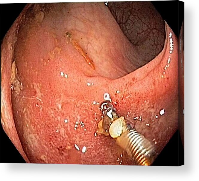 Endoscope View Acrylic Print featuring the photograph Ulcerative Proctitis In The Rectum by Gastrolab