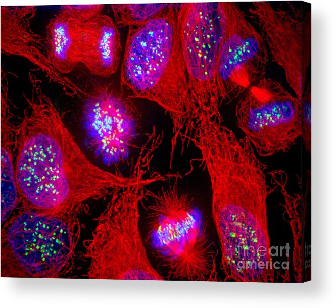 Cervical Carcinoma Cells Acrylic Print featuring the photograph Cervical Carcinoma Cells by Jennifer C Waters