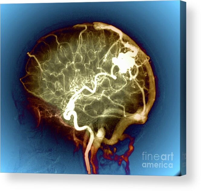 Abnormal Acrylic Print featuring the photograph Cerebral Arteriovenous Malformation #21 by Zephyr/science Photo Library