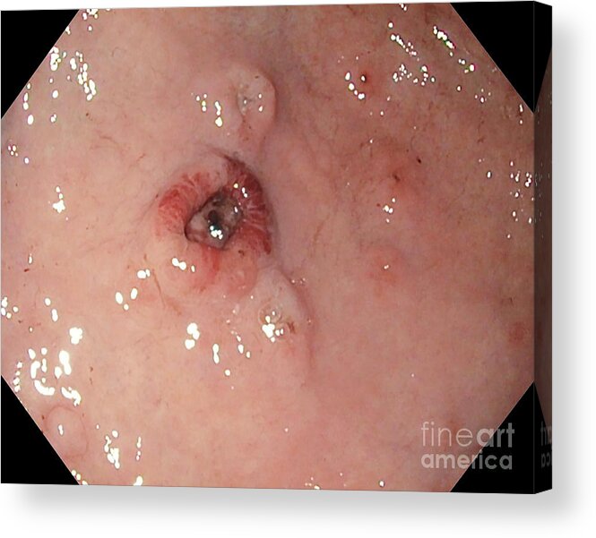 Gastric Lymphoma Acrylic Print featuring the photograph Ulceration In Gastric Lymphoma by Gastrolab/science Photo Library