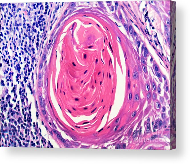 Light Micrograph Acrylic Print featuring the photograph Squamous Cell Carcinoma, Keratin Pearl #2 by Garry DeLong