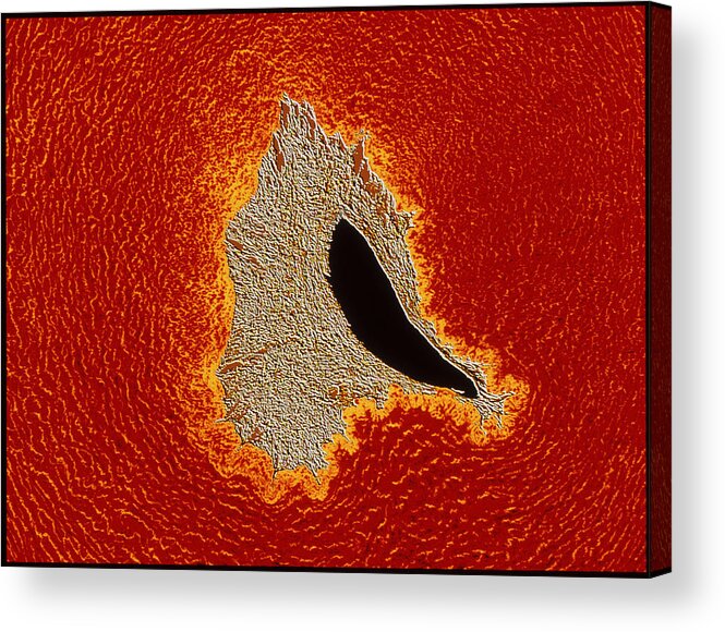 Magnified Image Acrylic Print featuring the photograph Atherosclerosis by Pasieka
