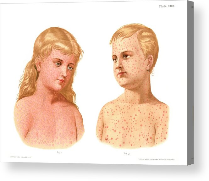 Condition Acrylic Print featuring the photograph Measles And German Measles by Us National Library Of Medicine/science Photo Library