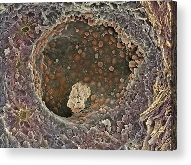 Breast Cancer Acrylic Print featuring the photograph Breast Cancer, Sem #4 by Steve Gschmeissner