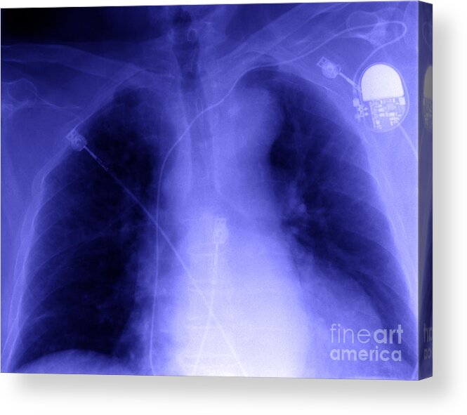 Xray Acrylic Print featuring the photograph X-ray Of Implanted Defibulator by Ted Kinsman