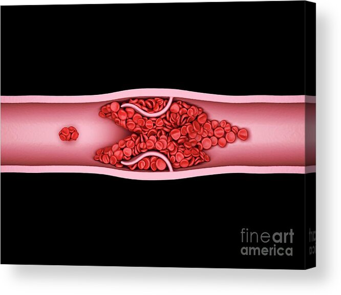 Abnormal Acrylic Print featuring the photograph Blood Clot #19 by Maurizio De Angelis/science Photo Library