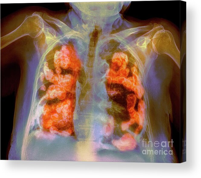 Abnormal Acrylic Print featuring the photograph Bilateral Pleural Calcification #4 by Science Photo Library