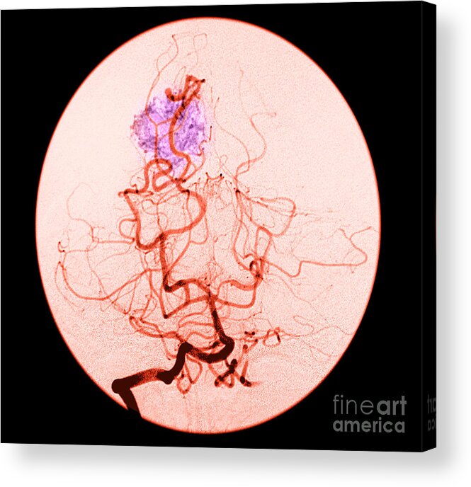 Abnormal Cerebral Angiogram Acrylic Print featuring the photograph Occipital Lobe Avm #3 by Medical Body Scans