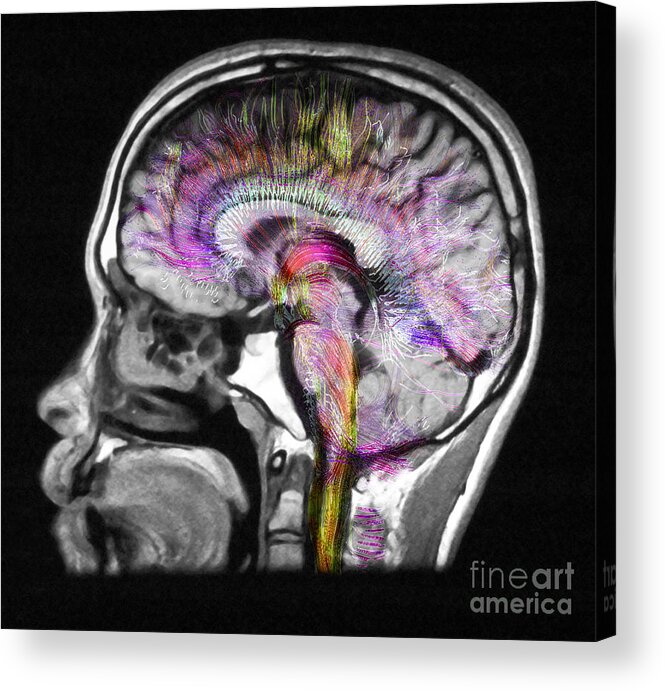 Mri Acrylic Print featuring the photograph Normal Brain, Fiber Tractography And Mri #3 by Scott Camazine