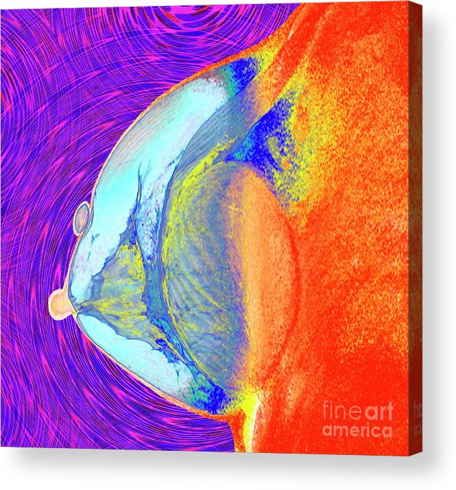 Breast Augmentation Acrylic Print featuring the photograph Breast Augmentation #2 by K H Fung/science Photo Library