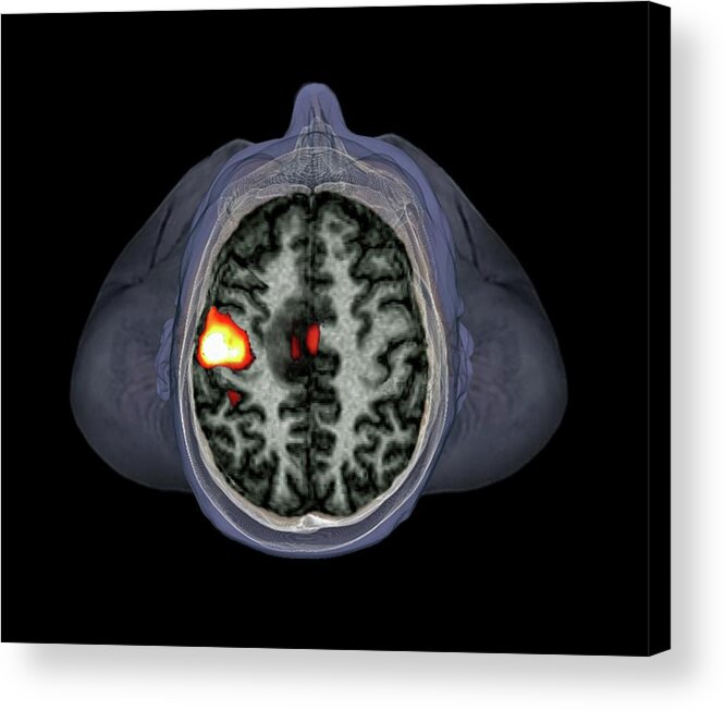 Human Acrylic Print featuring the photograph Brain Tumour #1 by Zephyr