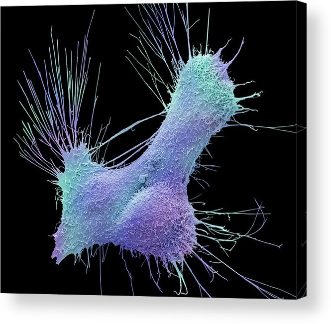 Condition Acrylic Print featuring the photograph Prostate Cancer Cells #2 by Steve Gschmeissner