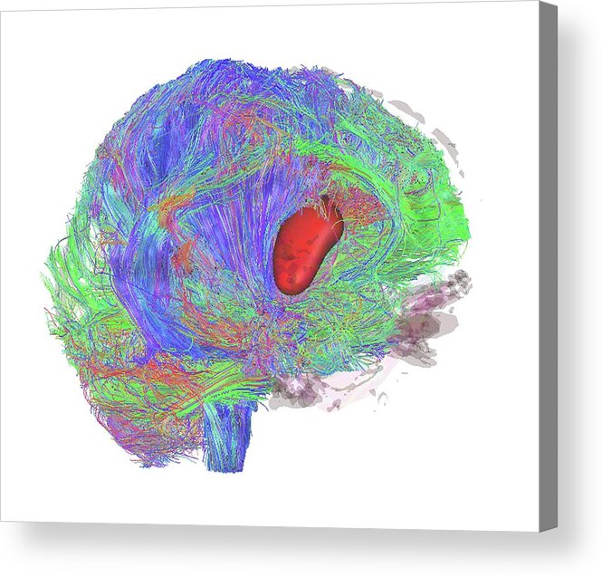 Motor Cortex Pathway Acrylic Print featuring the photograph Brain Tumour by Sherbrooke Connectivity Imaging Lab/science Photo Library
