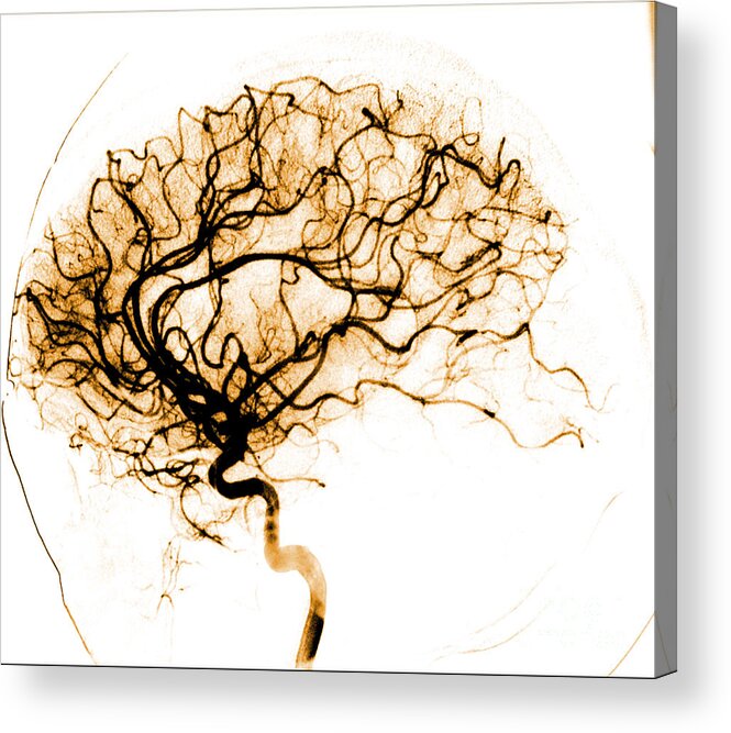 Catheter Cerebral Angiogram Acrylic Print featuring the photograph Cerebral Angiogram #4 by Medical Body Scans