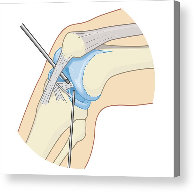 Adult Acrylic Print featuring the digital art Cross Section Biomedical Illustration Of Inside The Knee Joint During Rigid Endoscopy Procedure by Dorling Kindersley