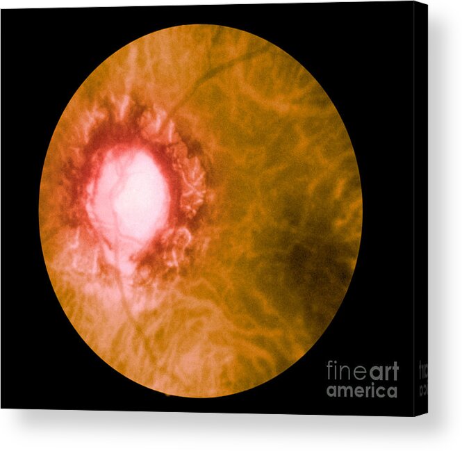 Bacteria Acrylic Print featuring the photograph Retina Infected By Syphilis by Science Source