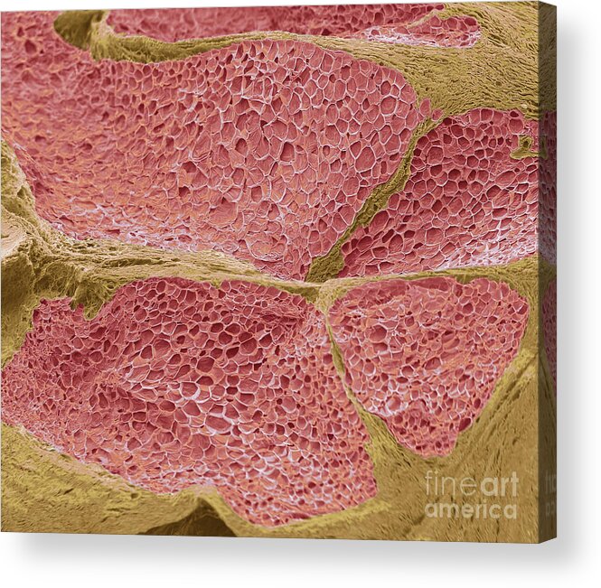 Condition Acrylic Print featuring the photograph Tumour Adipose Tissue #1 by Steve Gschmeissner/science Photo Library