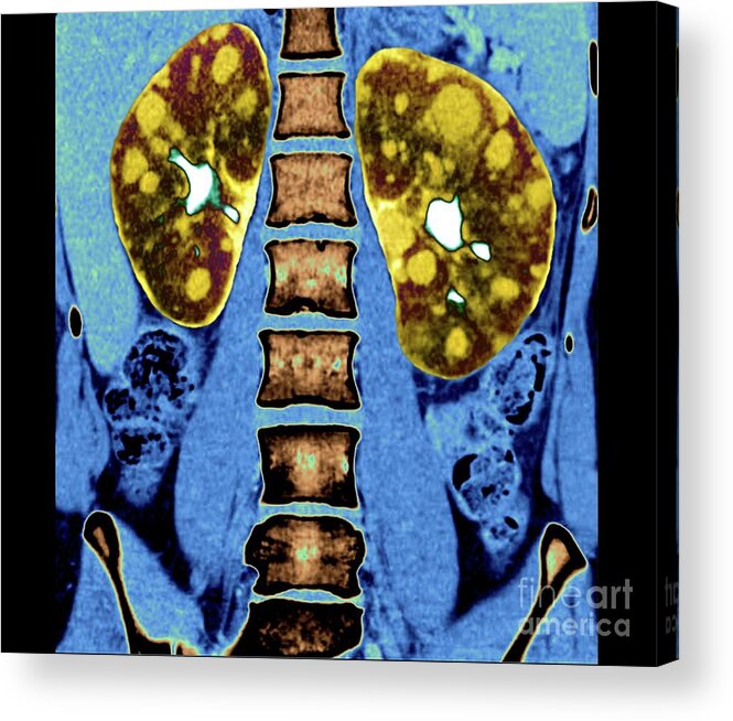 40s Acrylic Print featuring the photograph Polycystic Kidneys #7 by Zephyr/science Photo Library
