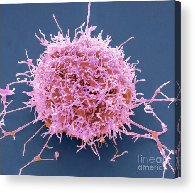 Asbestos Acrylic Print featuring the photograph Mesothelioma Cancer Cell by Steve Gschmeissner/science Photo Library
