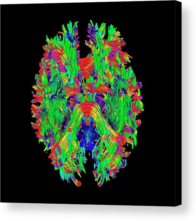 Glioma Acrylic Print featuring the photograph Brain Tumour #27 by Simon Fraser/science Photo Library