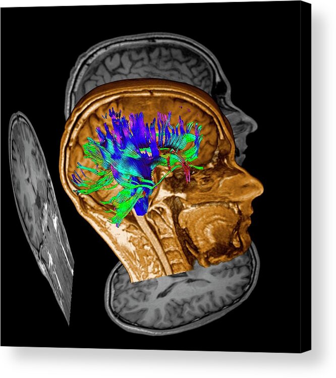 Glioma Acrylic Print featuring the photograph Brain Tumour #29 by Simon Fraser/science Photo Library