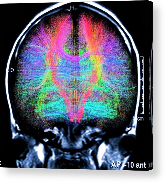 Brain Scan Acrylic Print featuring the photograph Brain Mri And White Matter Fibres by Alfred Pasieka/science Photo Library