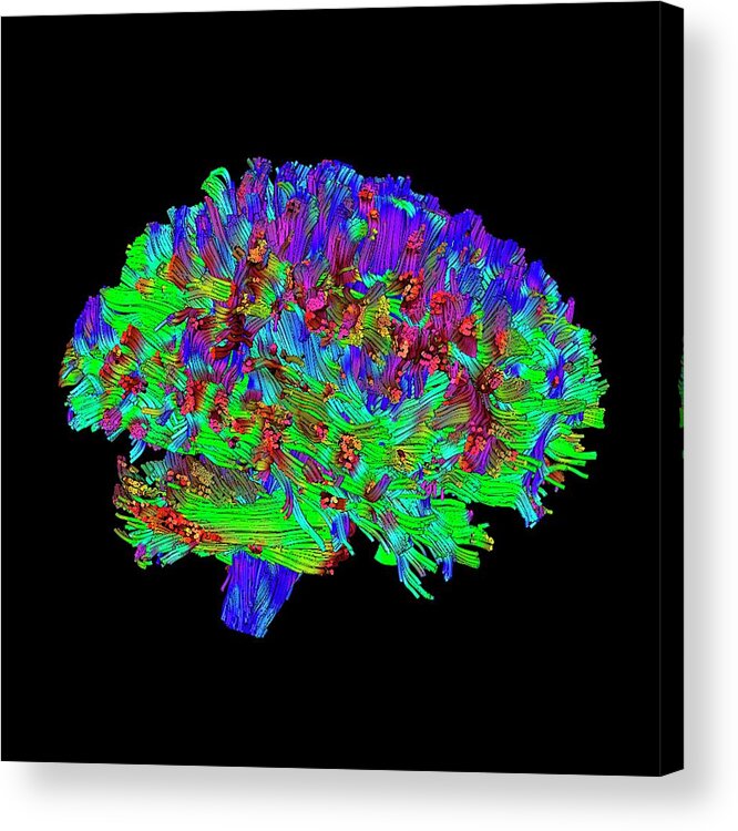 Glioma Acrylic Print featuring the photograph Brain Tumour #33 by Simon Fraser/science Photo Library