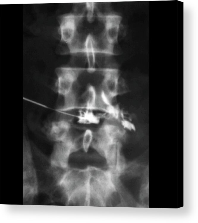 Black Background Acrylic Print featuring the photograph Slipped Disc #9 by Zephyr/science Photo Library
