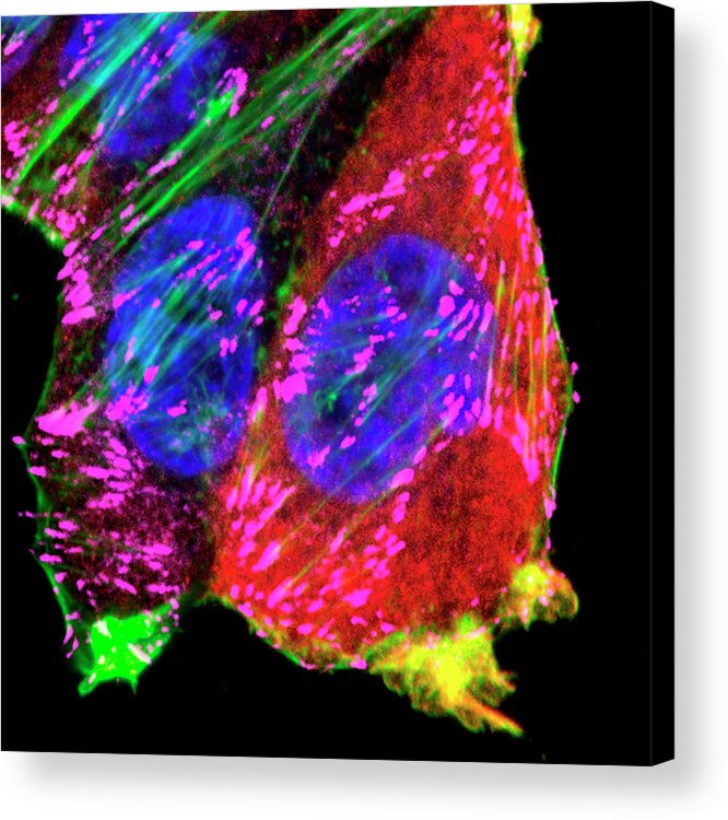 Cell Acrylic Print featuring the photograph Breast Cancer Adhesions by Massey Cancer Center At Virginia Commonwealth University/national Cancer Institute/science Photo Library