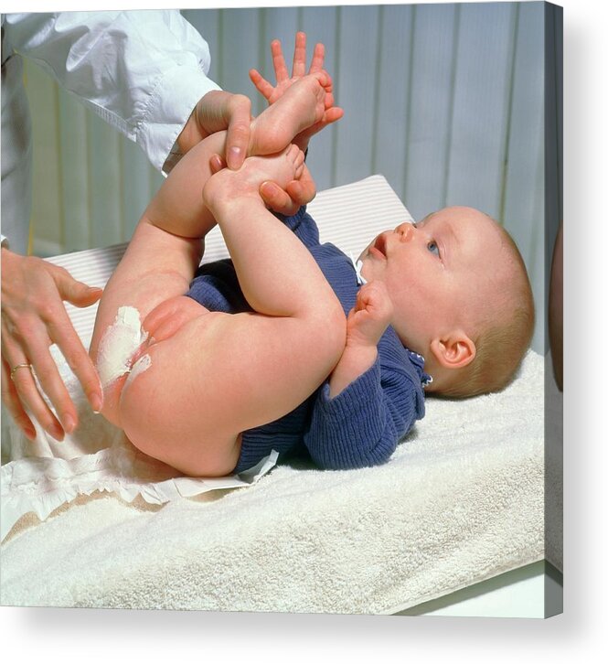 Cream On Baby Girl's Buttocks During Nappy Change Acrylic Print Cc Studio/science Photo Library - Gallery