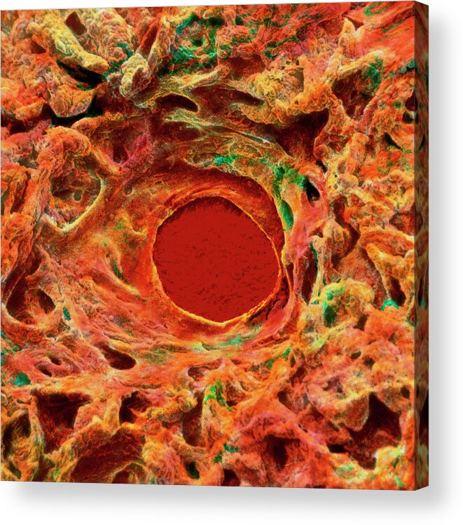 Ulcer Acrylic Print featuring the photograph Gastric Ulcer by Prof. J. James/science Photo Library