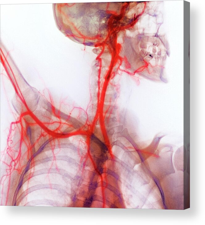Subclavian Artery Acrylic Print featuring the photograph Neck And Shoulder Arteries by Cnri