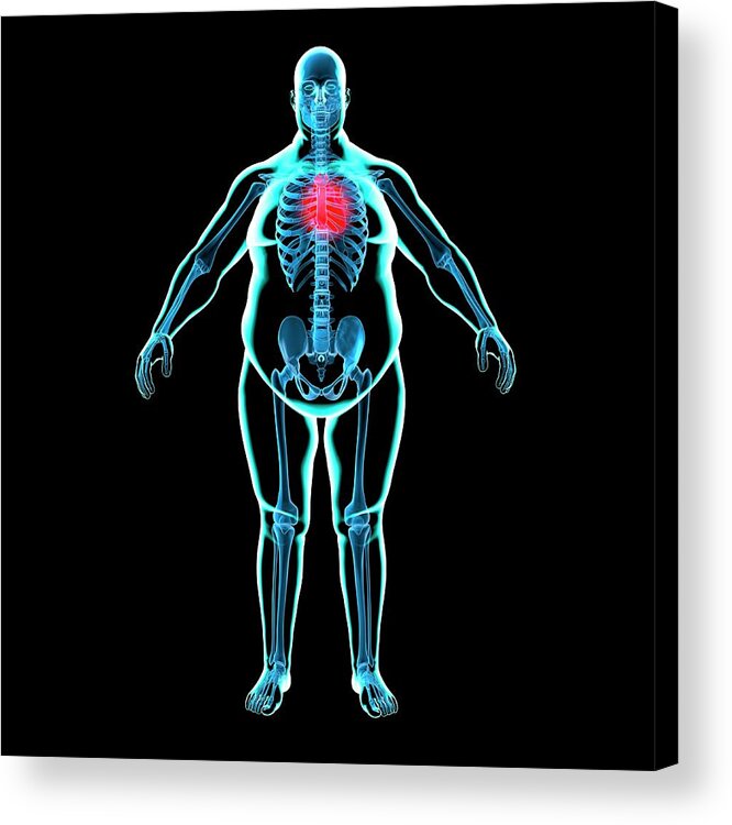 Risk Acrylic Print featuring the digital art Obese Mans Heart, Artwork by Science Photo Library - Roger Harris