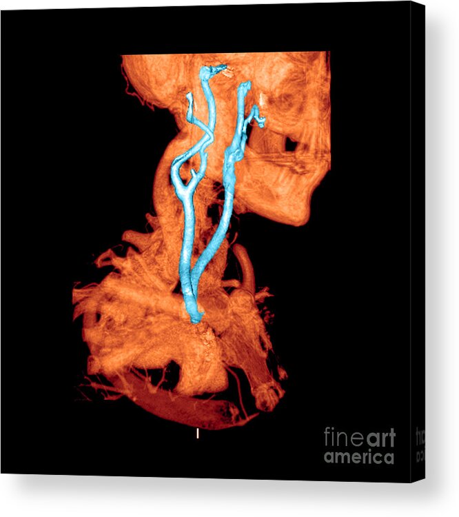 3 Dimensional Acrylic Print featuring the photograph 3d Cta Of Carotid Arteries #2 by Medical Body Scans