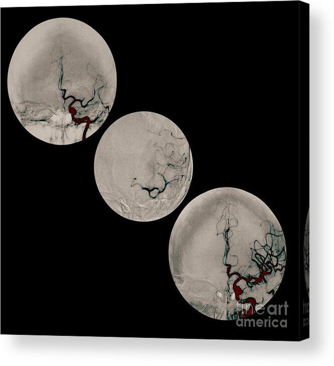 Angiogram Of Stroke Acrylic Print featuring the photograph Stroke Treatment by Medical Body Scans