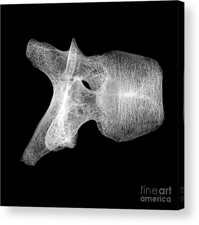 Science Acrylic Print featuring the photograph Human Vertebra T5, X-ray #7 by Ted Kinsman