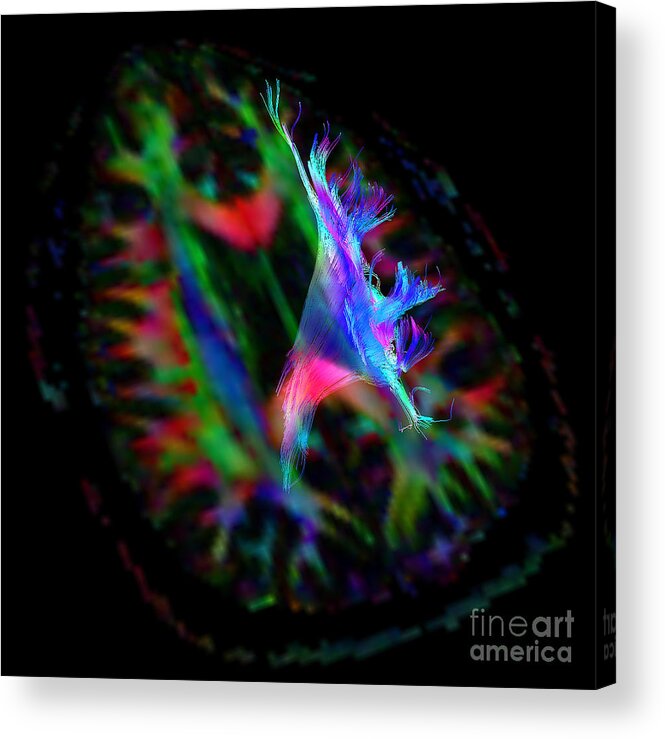 Brain Mri Acrylic Print featuring the photograph Corona Radiata, Diffuse Tensor Imaging by Living Art Enterprises