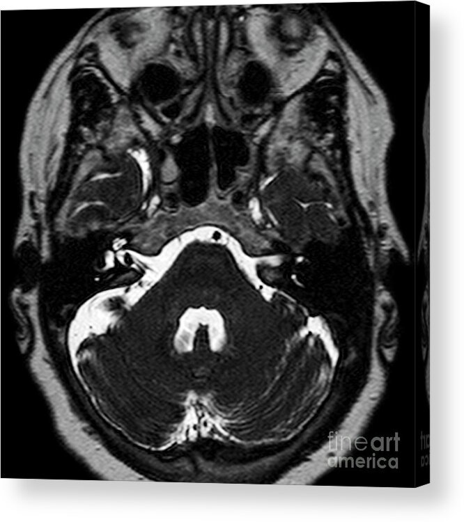 Neuroma Acrylic Print featuring the photograph Acoustic Neuroma #3 by Simon Fraser/science Photo Library