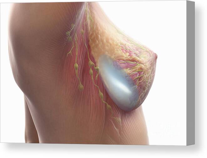 Transparent Canvas Print featuring the photograph Breast Implant #1 by Science Picture Co