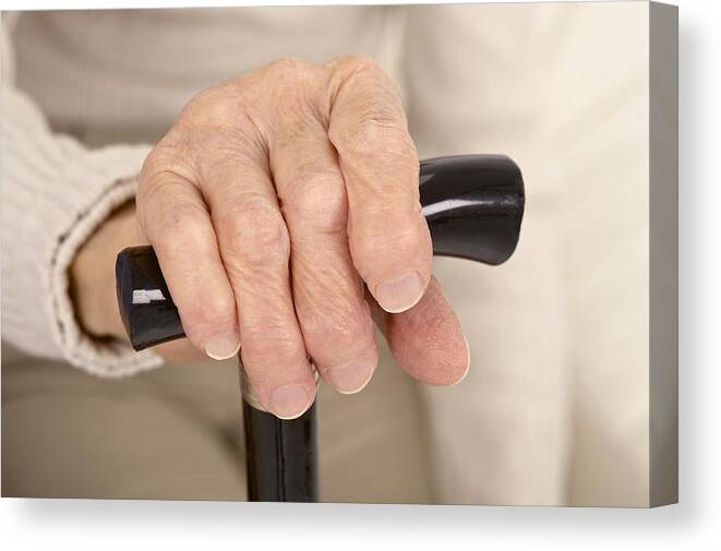 Arthritis Canvas Print featuring the photograph Arthritic hand and walking stick by Science Photo Library