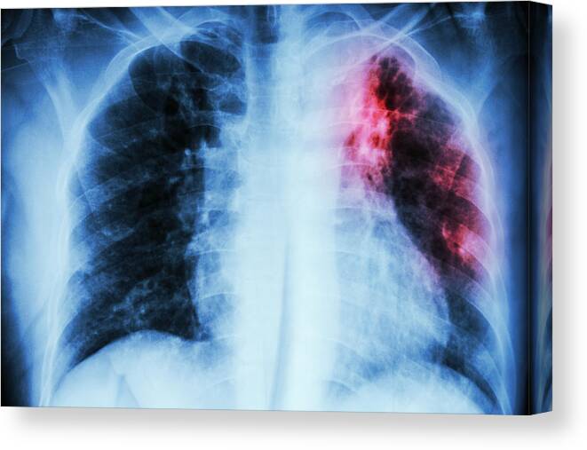 Pneumonia Canvas Print featuring the photograph Pulmonary Tuberculosis by Stockdevil