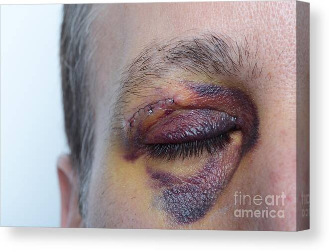 Adult Male Canvas Print featuring the photograph Black Eye by Photo Researchers, Inc.