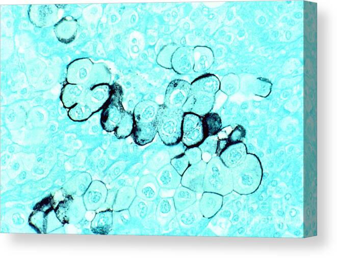 Pancreatic Cancer Canvas Print featuring the photograph Pancreatic Cancer Cells by Science Source